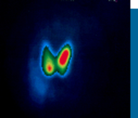 Bild einer Schilddrüse mit warmen Knoten während einer Radiojodtherapie