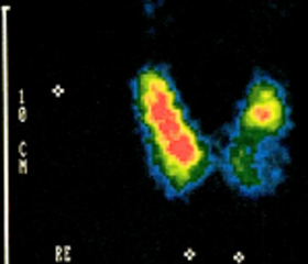 Bild eines Sonografisch hypoluzenten Knotens links unten
