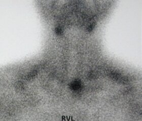 Bild eines Kleinen aktiven Schilddrüsenrest nach Operation