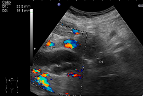 Konventionelles Ultraschallbild bei einer Patientin mit einem Bauchspeicheldrüsentumor. Echoarmer (= dunkler) kugeliger Tumor im der Bildmitte, der zu einer Erweiterung der Gallenwege (von 9 Uhr zur Bildmitte ziehend) geführt hat; farbige Darstellung de